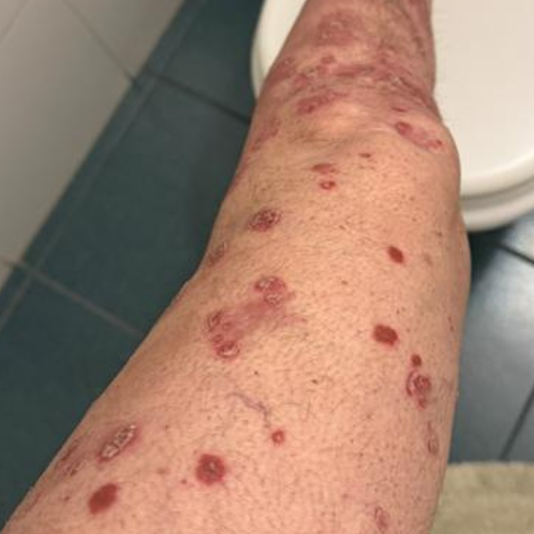 Antes: piel con placas y enrojecimiento